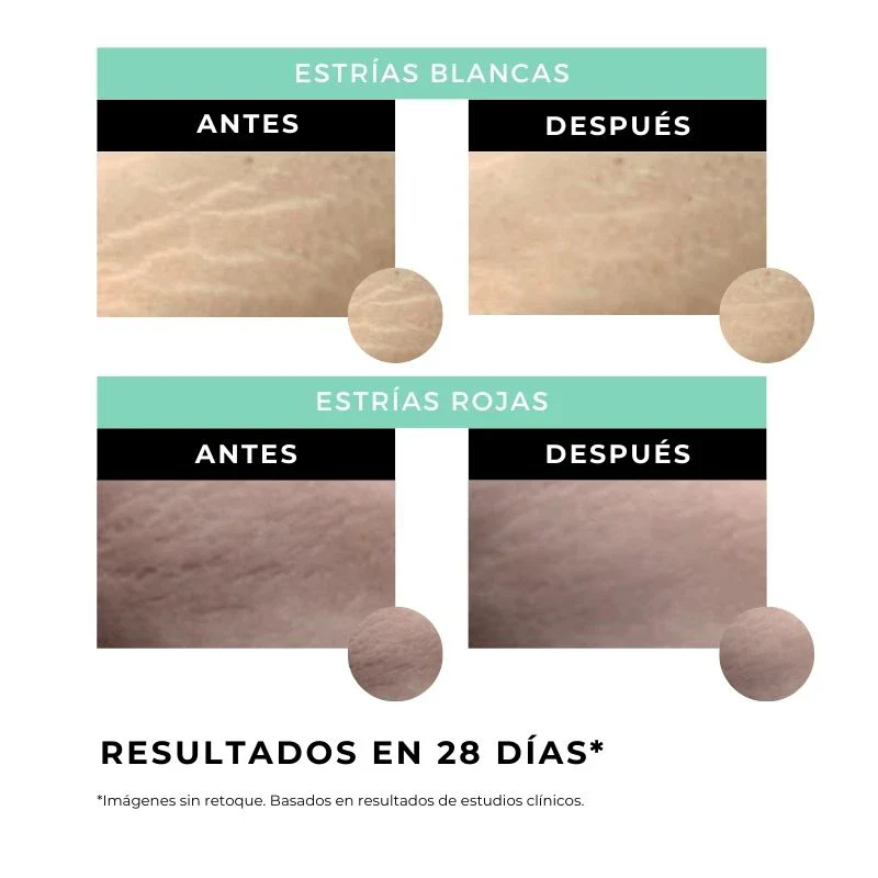 Crema antiestrías - Image 4